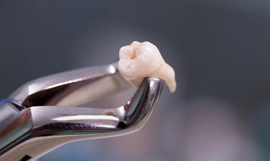 7 Biaya Cabut Gigi 2026 di Semua Klinik dan Rumah Sakit