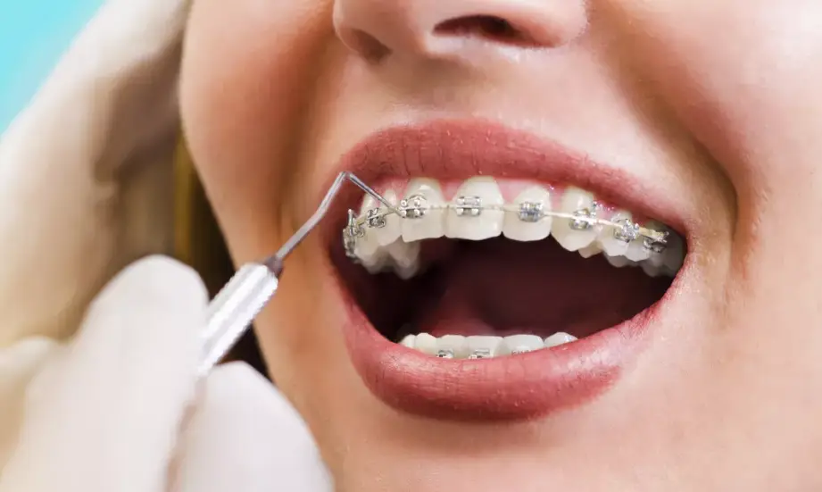 5 Biaya Pasang Behel 2026 di Semua Klinik/Rumah Sakit